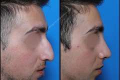 nose-surgery-0234
