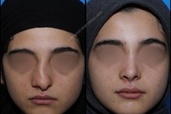 nose-surgery-0235