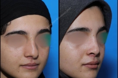 nose-surgery-0236