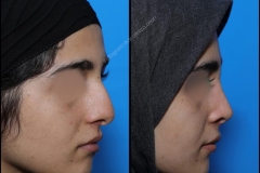nose-surgery-0237