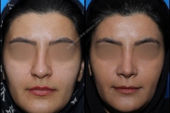 nose-surgery-0238