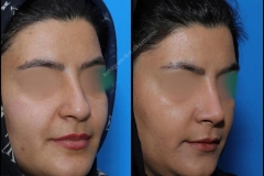 nose-surgery-0239