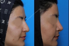nose-surgery-0240