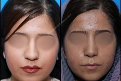 nose-surgery-0241