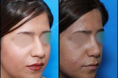 nose-surgery-0242
