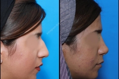 nose-surgery-0243