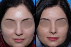 nose-surgery-0244