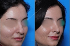 nose-surgery-0245