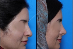nose-surgery-0246