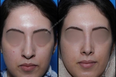 nose-surgery-0247