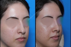 nose-surgery-0248