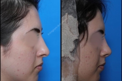 nose-surgery-0249