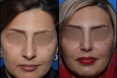nose-surgery-0250
