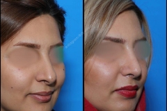 nose-surgery-0251