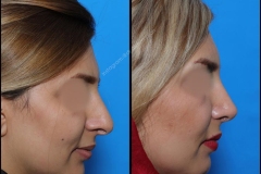 nose-surgery-0252