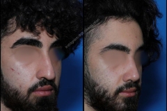 nose-surgery-0254