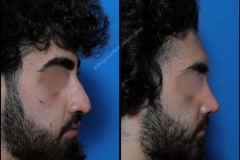 nose-surgery-0255