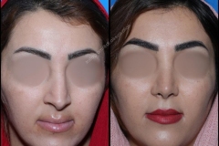 nose-surgery-0256