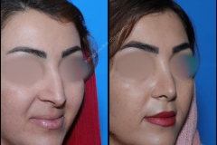 nose-surgery-0257