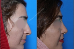 nose-surgery-0258