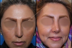 nose-surgery-0259