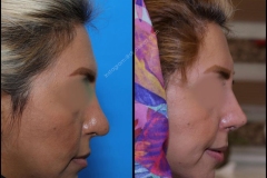 nose-surgery-0260
