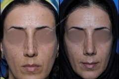 nose-surgery-0261
