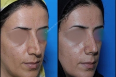 nose-surgery-0262