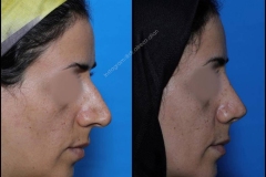 nose-surgery-0263