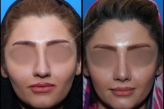 nose-surgery-0264