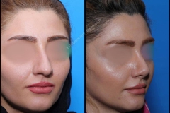 nose-surgery-0265