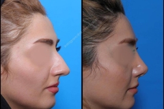 nose-surgery-0266