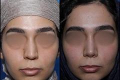 nose-surgery-0267
