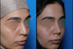 nose-surgery-0268