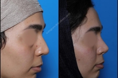 nose-surgery-0269