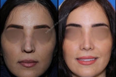 nose-surgery-0270