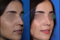 nose-surgery-0271