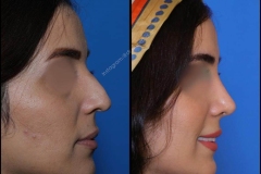 nose-surgery-0272