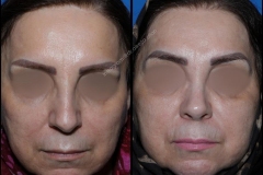 nose-surgery-0273
