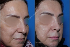 nose-surgery-0274