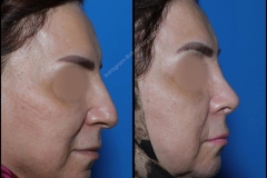 nose-surgery-0275