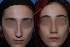 nose-surgery-0276