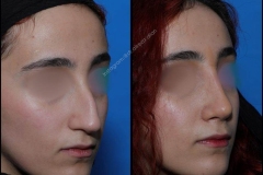 nose-surgery-0277