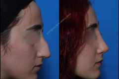 nose-surgery-0278