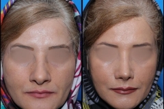 nose-surgery-0279