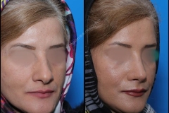 nose-surgery-0280