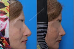 nose-surgery-0281