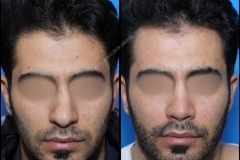 nose-surgery-0282