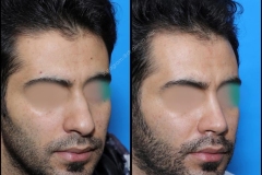 nose-surgery-0283