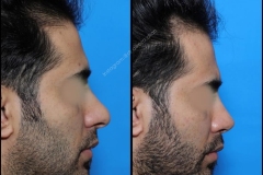 nose-surgery-0284